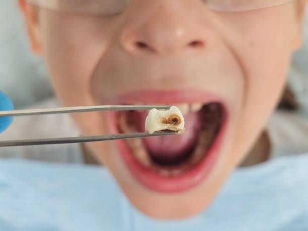 Best Broken or Cracked Tooth Emergency Dentist in Benton Park, CA